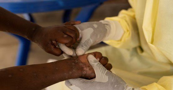 MPOX Clade 1b