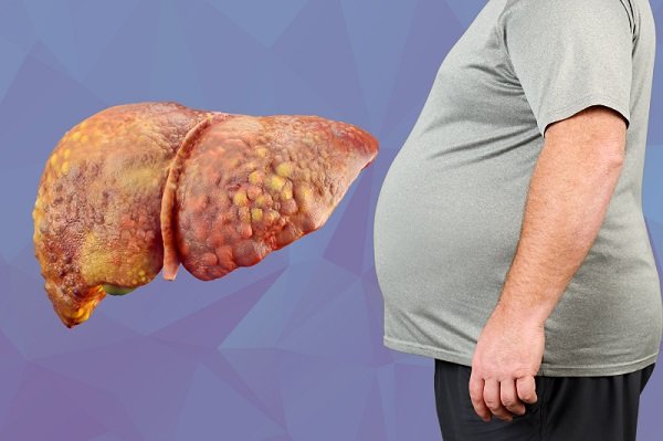 पुरुषों से ज्यादा महिलाओं में Fatty Liver का खतरा! क्या कहती है रिसर्च और एक्सपर्ट की राय?